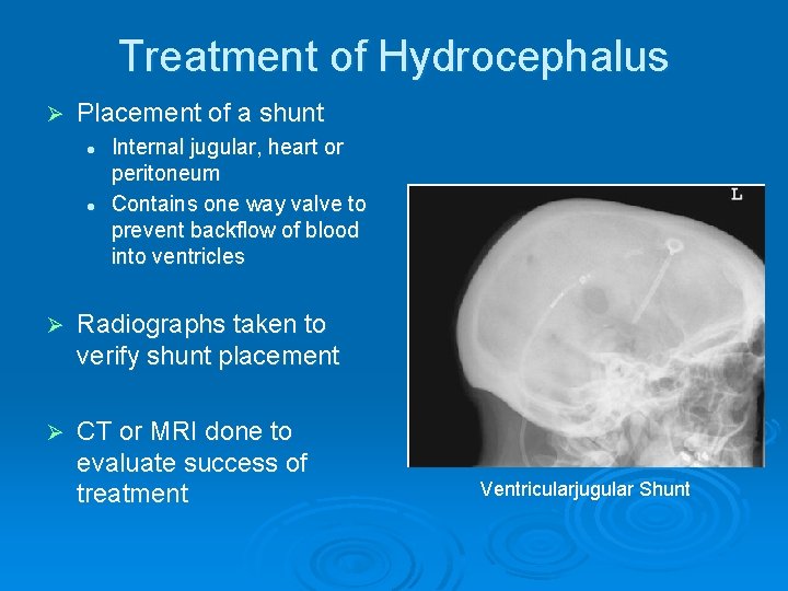 Treatment of Hydrocephalus Ø Placement of a shunt l l Internal jugular, heart or