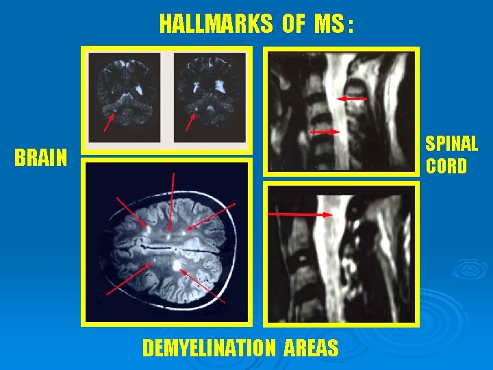 HALLMARKS OF MS : SPINAL CORD BRAIN DEMYELINATION AREAS 