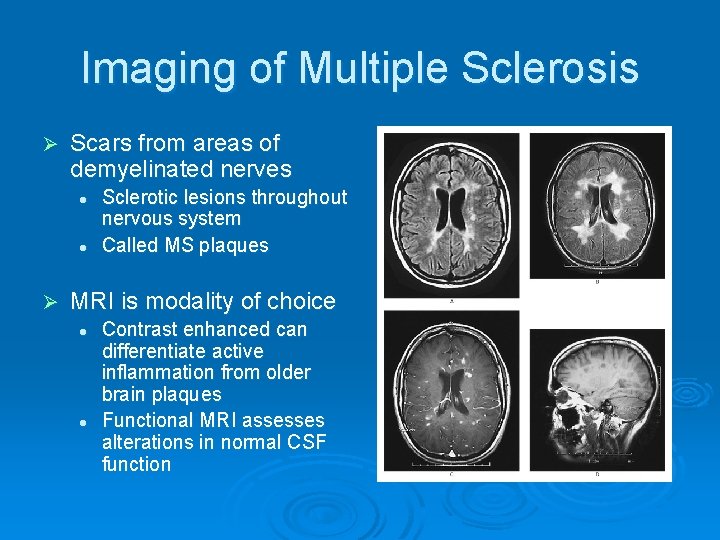 Imaging of Multiple Sclerosis Ø Scars from areas of demyelinated nerves l l Ø