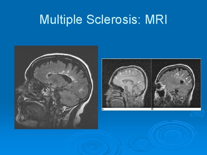 Multiple Sclerosis: MRI 