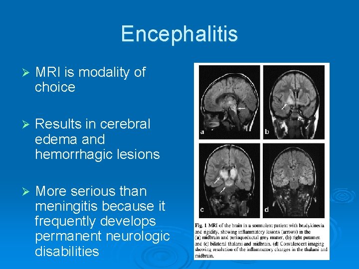 Encephalitis Ø MRI is modality of choice Ø Results in cerebral edema and hemorrhagic