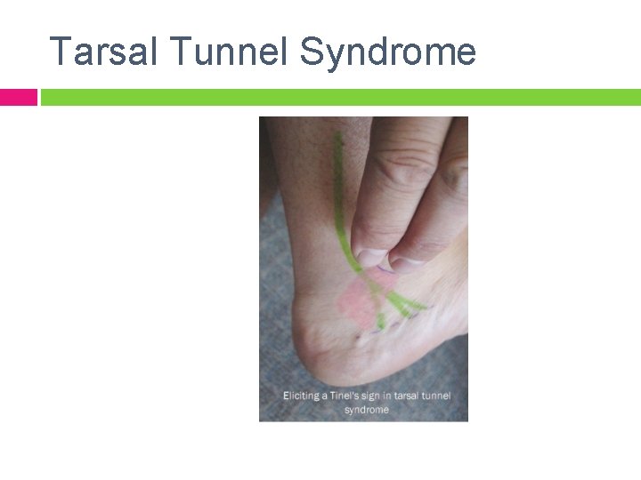 Tarsal Tunnel Syndrome 