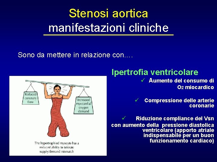 Stenosi aortica manifestazioni cliniche Sono da mettere in relazione con…. Ipertrofia ventricolare ü Aumento