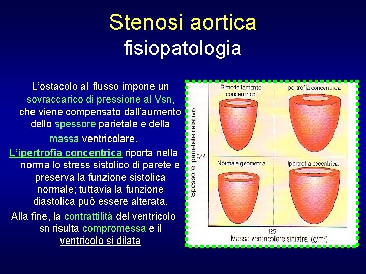 Stenosi aortica fisiopatologia L’ostacolo al flusso impone un sovraccarico di pressione al Vsn, che