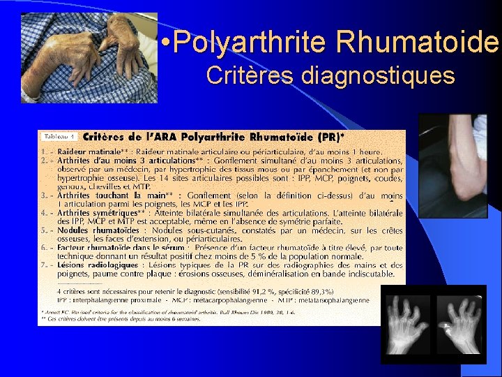  • Polyarthrite Rhumatoide Critères diagnostiques 