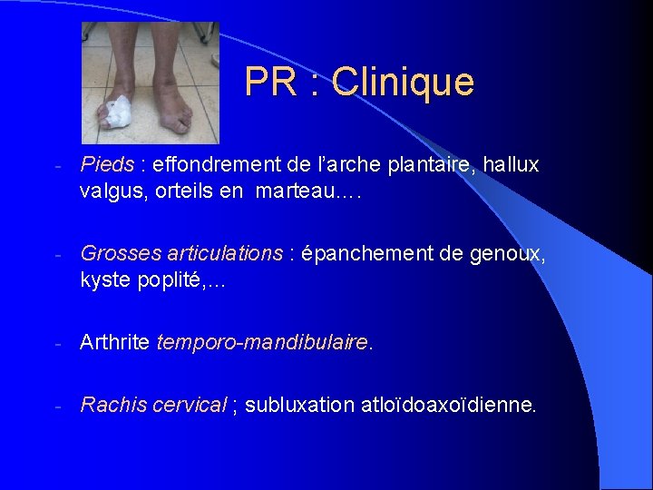 PR : Clinique - Pieds : effondrement de l’arche plantaire, hallux valgus, orteils en