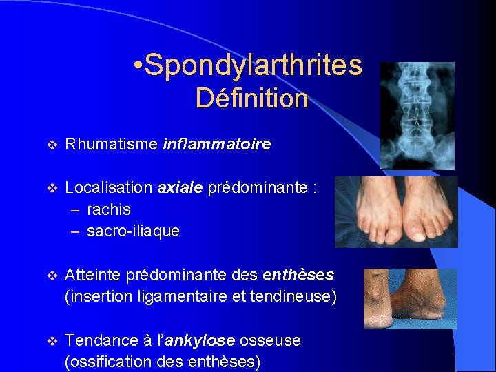  • Spondylarthrites Définition v Rhumatisme inflammatoire v Localisation axiale prédominante : – rachis