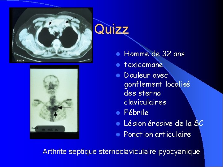 Quizz l l l Homme de 32 ans toxicomane Douleur avec gonflement localisé des