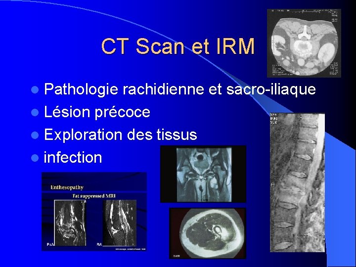 CT Scan et IRM l Pathologie rachidienne et sacro-iliaque l Lésion précoce l Exploration