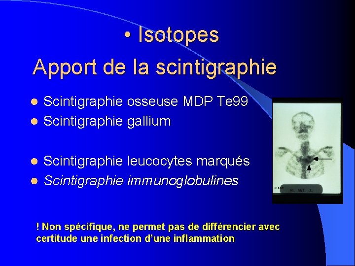  • Isotopes Apport de la scintigraphie Scintigraphie osseuse MDP Te 99 l Scintigraphie
