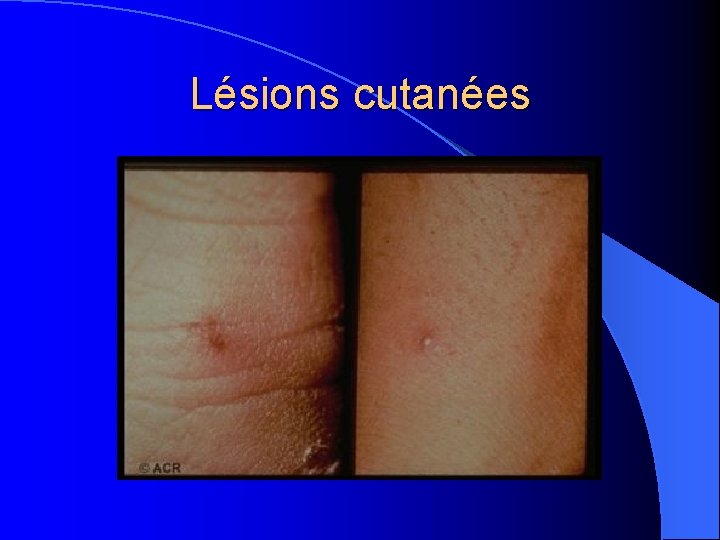 Lésions cutanées 