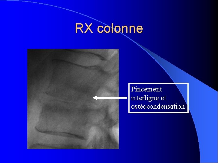 RX colonne Pincement interligne et ostéocondensation 
