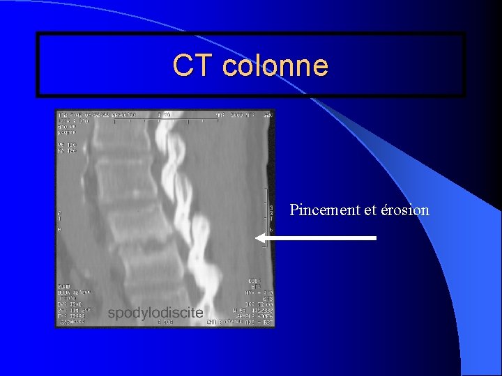 CT colonne Pincement et érosion 