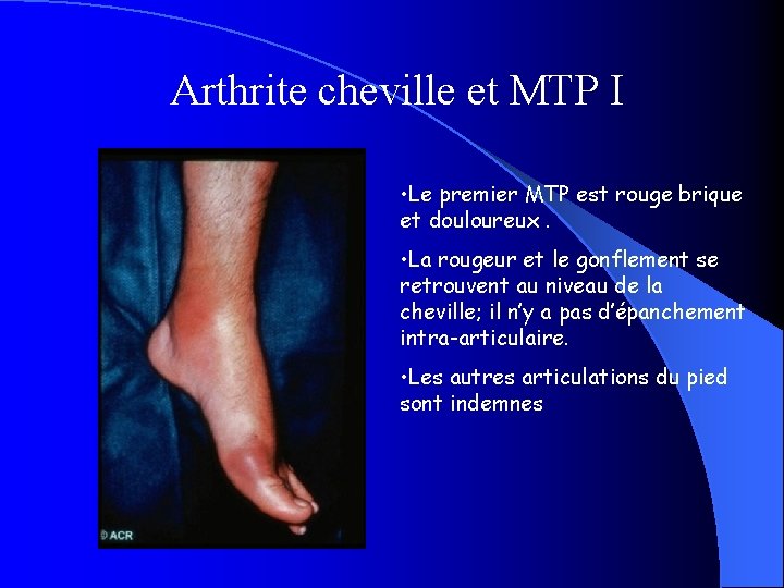 Arthrite cheville et MTP I • Le premier MTP est rouge brique et douloureux.