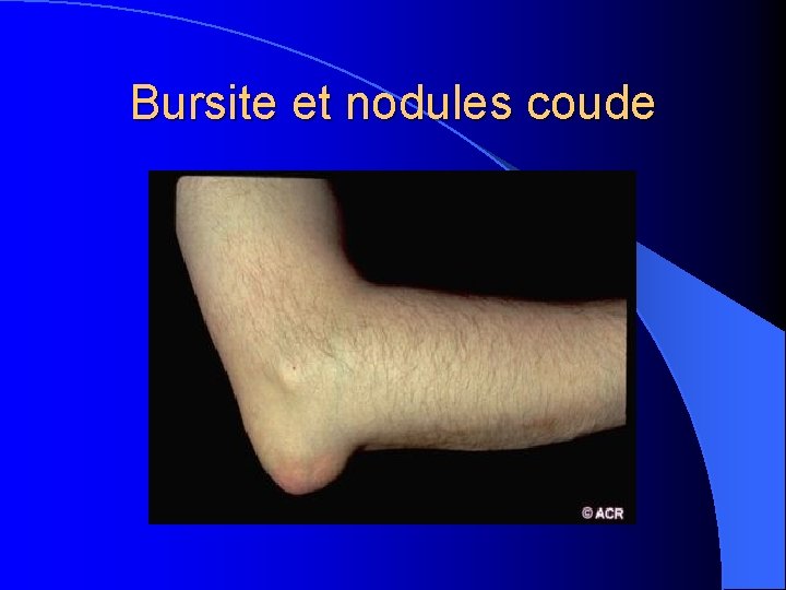 Bursite et nodules coude 