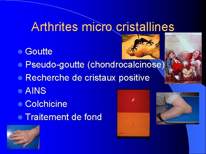 Arthrites micro cristallines l Goutte l Pseudo-goutte (chondrocalcinose) l Recherche de cristaux positive l