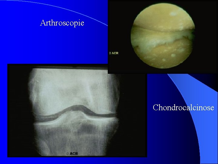 Arthroscopie Chondrocalcinose 