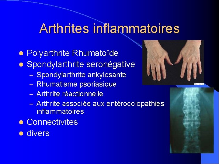 Arthrites inflammatoires Polyarthrite Rhumatoïde l Spondylarthrite seronégative l – – Spondylarthrite ankylosante Rhumatisme psoriasique