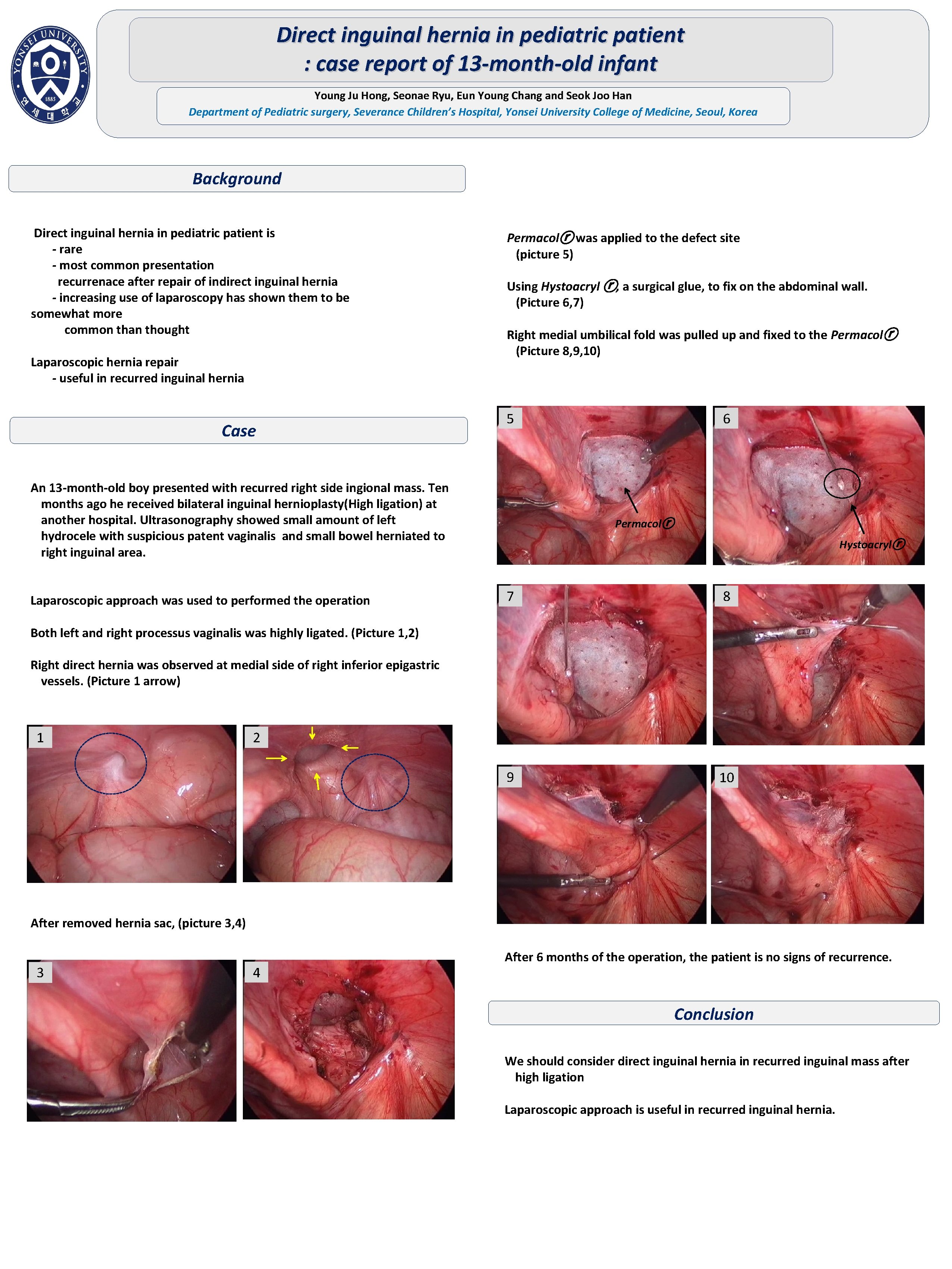 Direct inguinal hernia in pediatric patient : case report of 13 -month-old infant Young