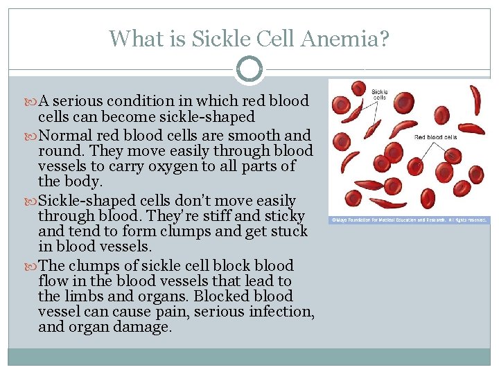 What is Sickle Cell Anemia? A serious condition in which red blood cells can