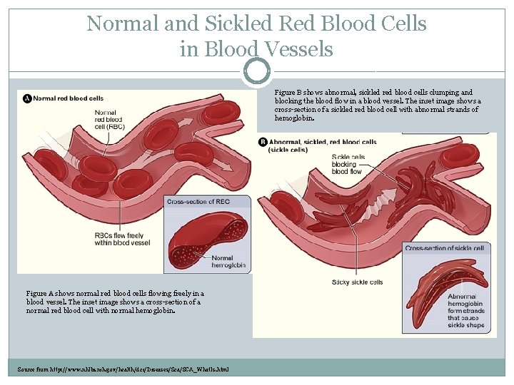 Normal and Sickled Red Blood Cells in Blood Vessels Figure B shows abnormal, sickled