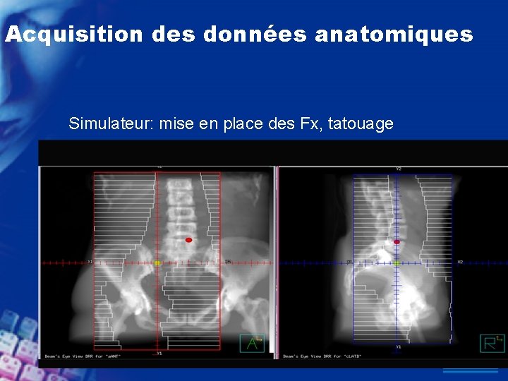 Acquisition des données anatomiques Simulateur: mise en place des Fx, tatouage 