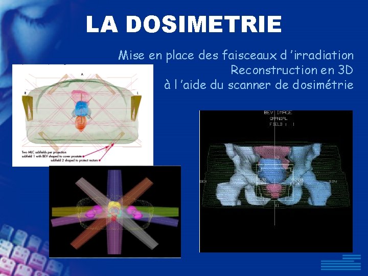 LA DOSIMETRIE Mise en place des faisceaux d ’irradiation Reconstruction en 3 D à