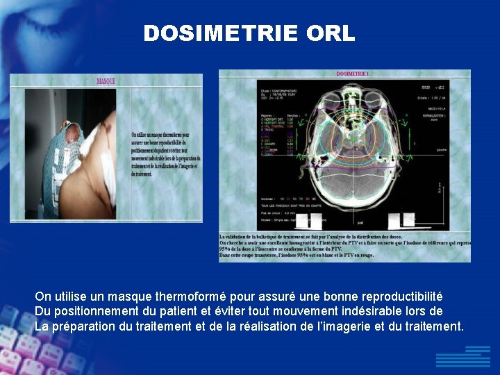 DOSIMETRIE ORL On utilise un masque thermoformé pour assuré une bonne reproductibilité Du positionnement