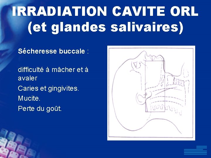 IRRADIATION CAVITE ORL (et glandes salivaires) Sécheresse buccale : difficulté à mâcher et à