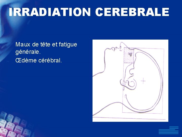 IRRADIATION CEREBRALE Maux de tête et fatigue générale. Œdème cérébral. 