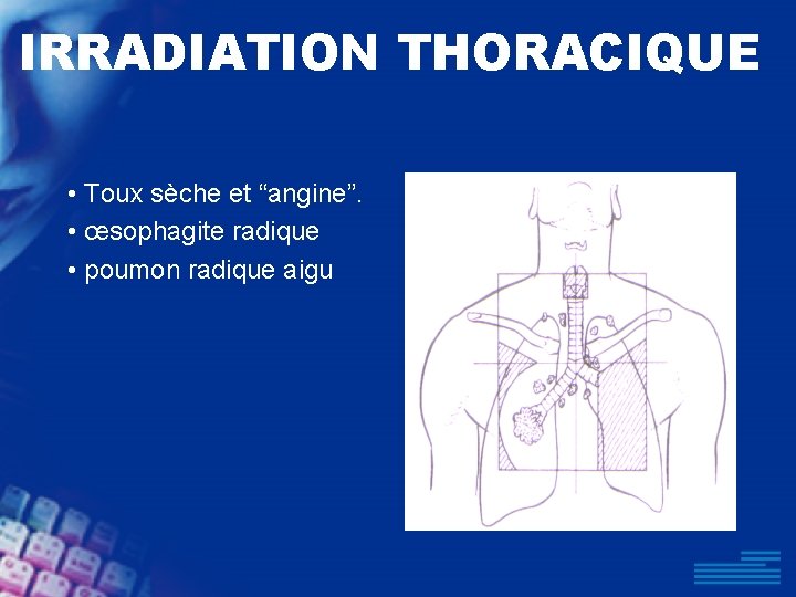 IRRADIATION THORACIQUE • Toux sèche et “angine”. • œsophagite radique • poumon radique aigu
