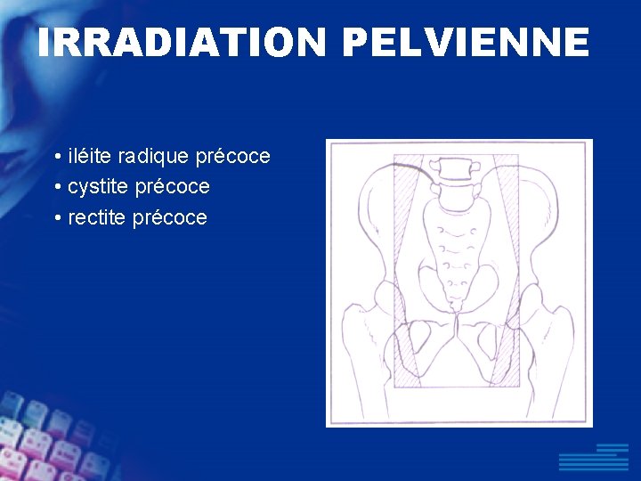 IRRADIATION PELVIENNE • iléite radique précoce • cystite précoce • rectite précoce 