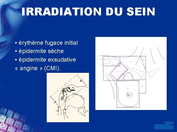 IRRADIATION DU SEIN • érythème fugace initial • épidermite sèche • épidermite exsudative «