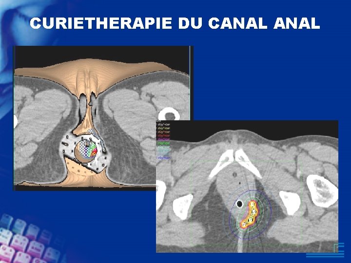 CURIETHERAPIE DU CANAL 