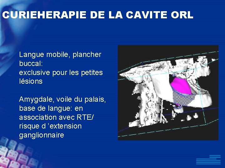 CURIEHERAPIE DE LA CAVITE ORL Langue mobile, plancher buccal: exclusive pour les petites lésions