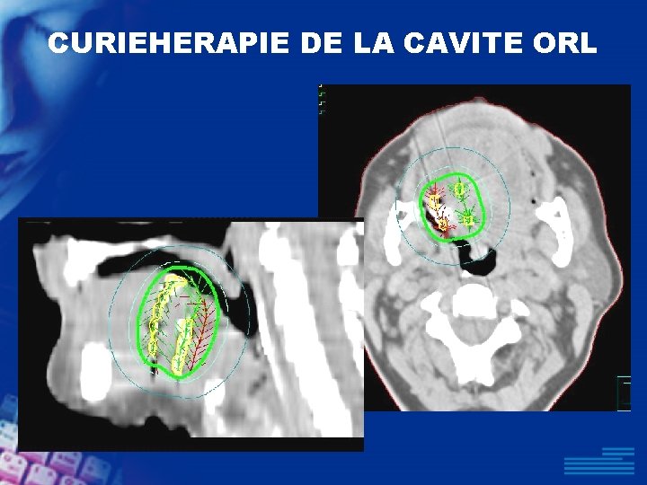 CURIEHERAPIE DE LA CAVITE ORL 