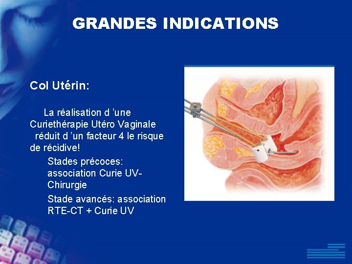 GRANDES INDICATIONS Col Utérin: La réalisation d ’une Curiethérapie Utéro Vaginale réduit d ’un