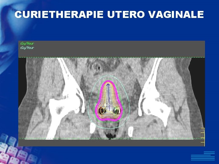CURIETHERAPIE UTERO VAGINALE 