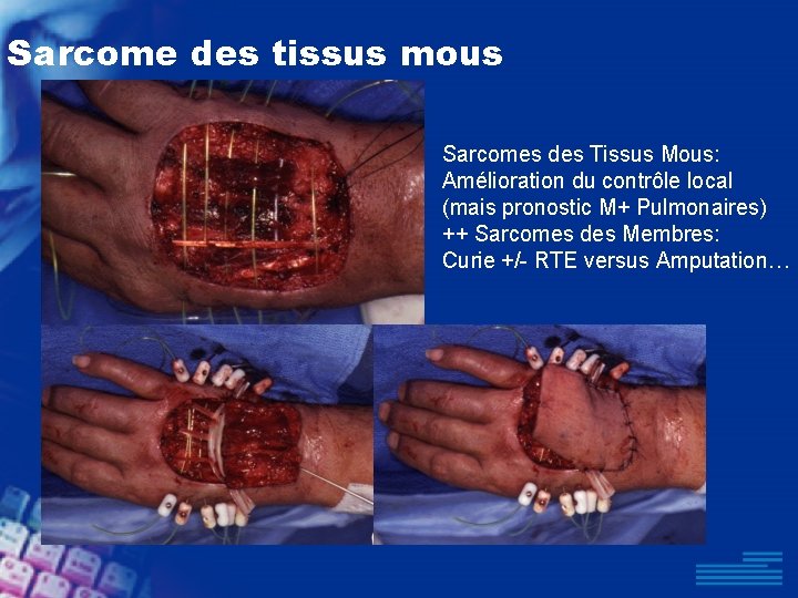 Sarcome des tissus mous Sarcomes des Tissus Mous: Amélioration du contrôle local (mais pronostic