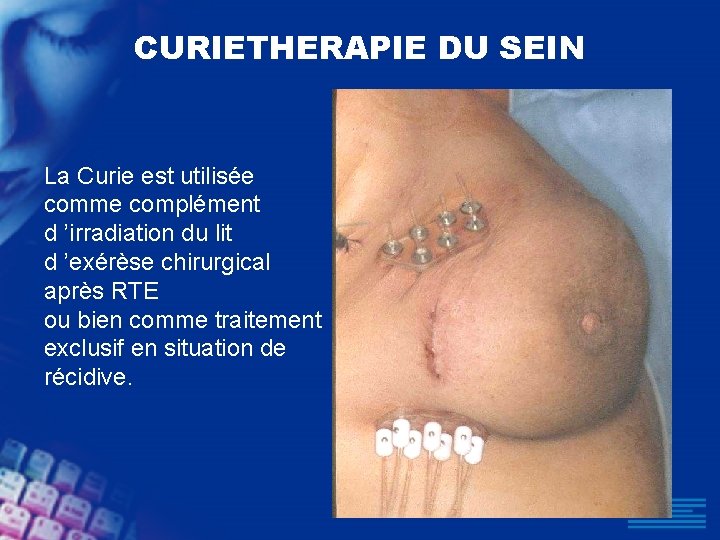 CURIETHERAPIE DU SEIN La Curie est utilisée comme complément d ’irradiation du lit d