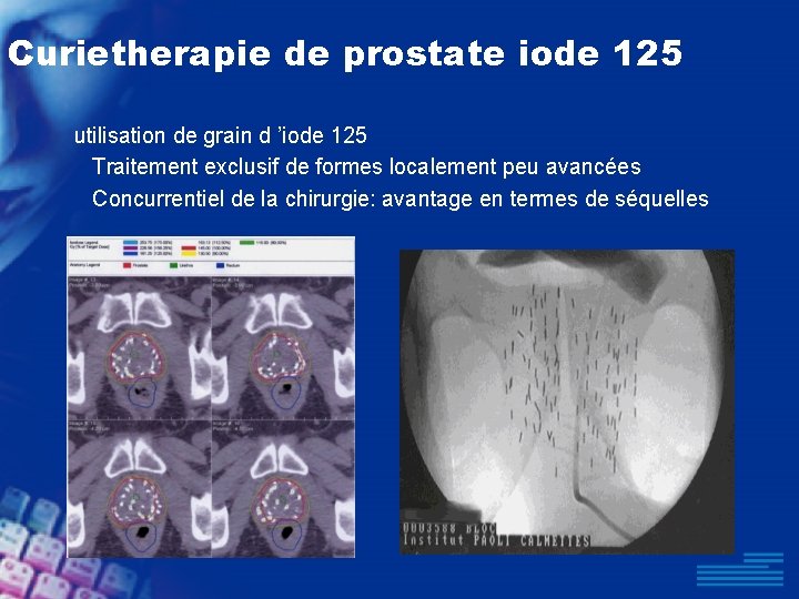 Curietherapie de prostate iode 125 utilisation de grain d ’iode 125 Traitement exclusif de