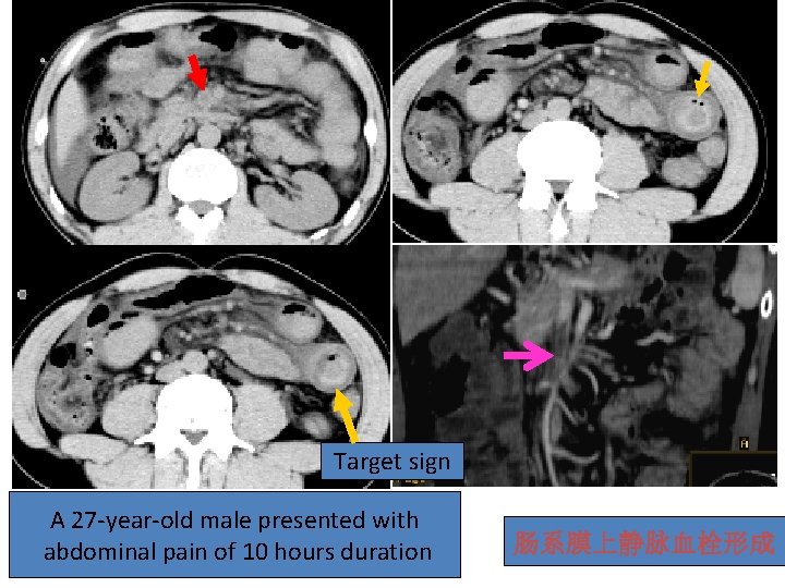 Target sign A 27 -year-old male presented with abdominal pain of 10 hours duration