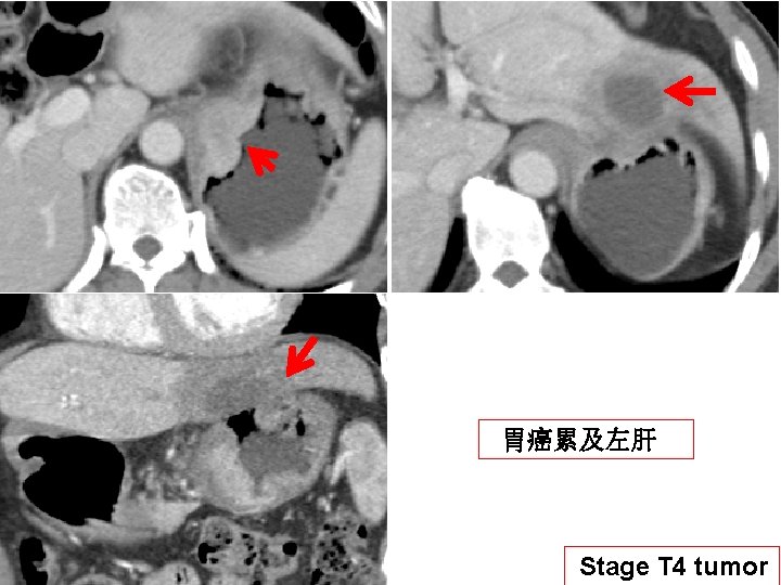 胃癌累及左肝 Stage T 4 tumor 