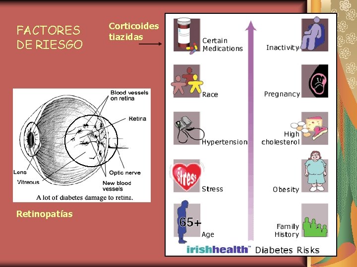 FACTORES DE RIESGO Retinopatías Corticoides tiazidas 