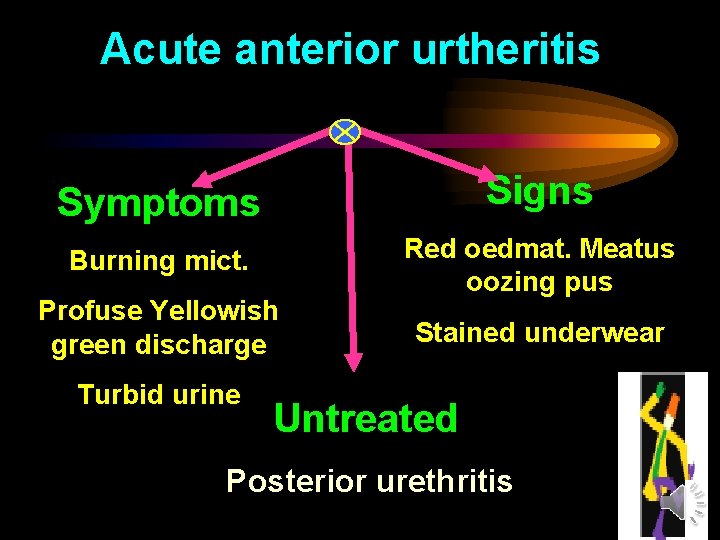 Acute anterior urtheritis Symptoms Signs Burning mict. Red oedmat. Meatus oozing pus Profuse Yellowish