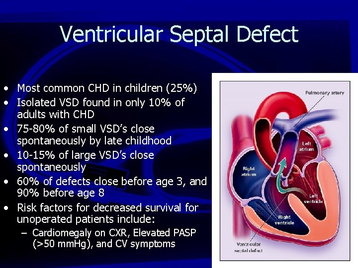 Ventricular Septal Defect • Most common CHD in children (25%) • Isolated VSD found