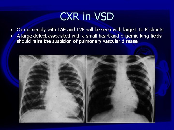 CXR in VSD • Cardiomegaly with LAE and LVE will be seen with large