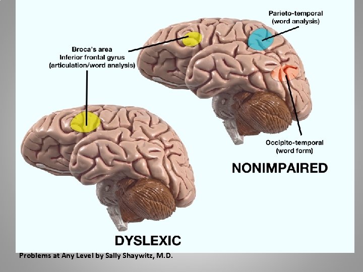 Source: Overcoming Dyslexia: A New and Complete Science Based Program for Reading Problems at