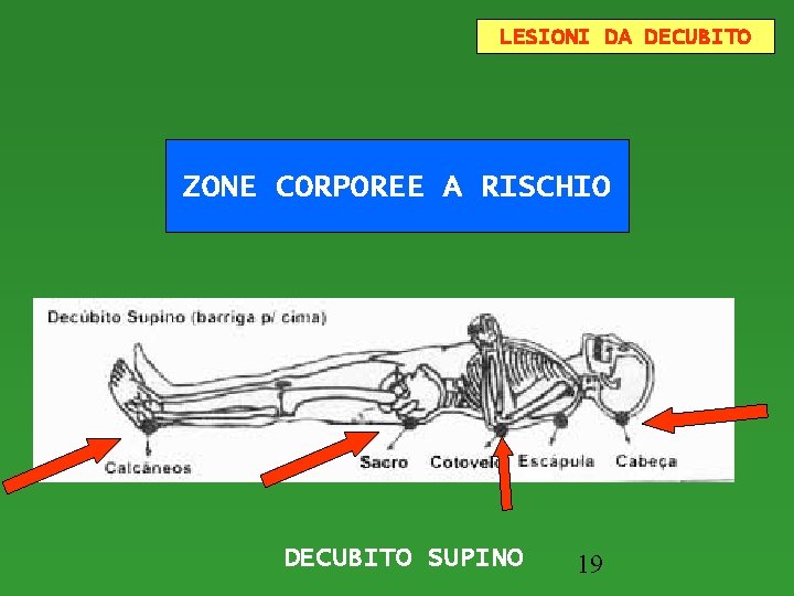 LESIONI DA DECUBITO ZONE CORPOREE A RISCHIO DECUBITO SUPINO 19 