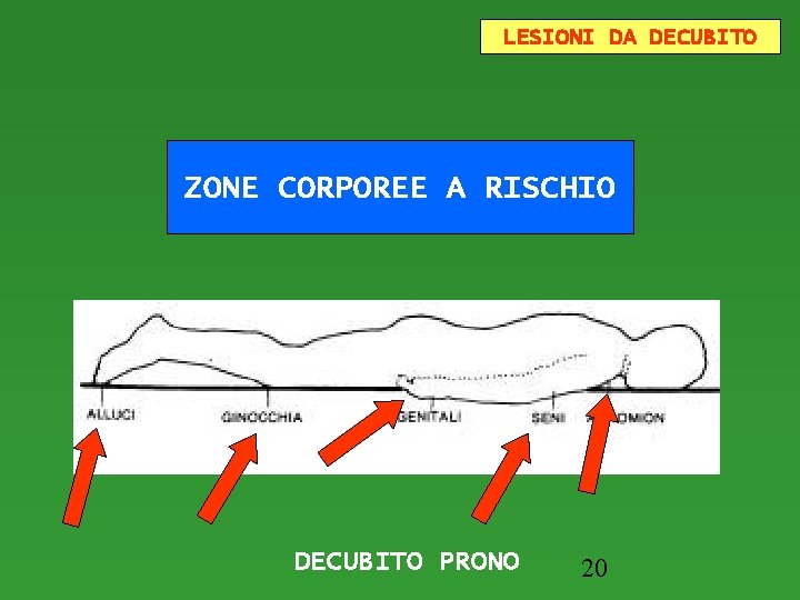 LESIONI DA DECUBITO ZONE CORPOREE A RISCHIO DECUBITO PRONO 20 